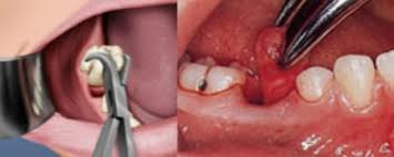 Có nên nhổ răng vĩnh viễn?