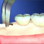Những điều cần biết về nhổ răng