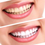 Những điều cần biết về tẩy trắng răng