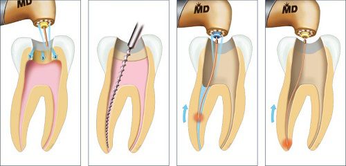 Quy trình điều trị tủy răng