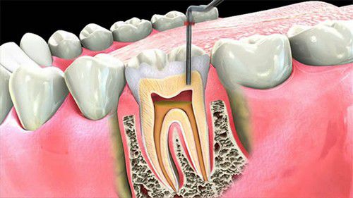 Điều trị tủy răng sẽ gây ra đau