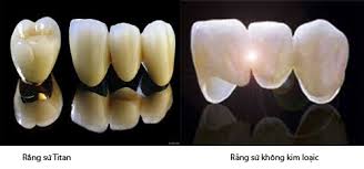Bọc răng sứ đạt hiệu quả cao nhất và phòng tránh việc sâu răng