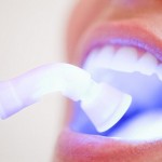 Các cách tẩy trắng răng phổ biến