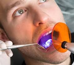Tẩy trắng răng có tác dụng phụ không ?
