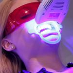 Quy trình tẩy trắng răng tại phòng khám