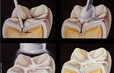 Chữa trị dứt điểm tình trạng sâu răng