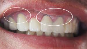 Răng sứ titan là một lựa cọn được ưa chuộng để xử lí những vấn đề về răng miệng