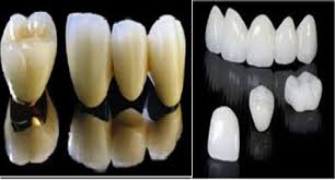 Răng sứ Titan sẽ là một giải pháp tuyệt vời cho vấn đề răng của bạn