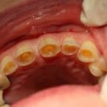 Răng bị mòn mặt nhai