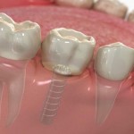 Trồng răng giả kịp thời cho răng bị mất