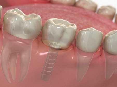 Trồng răng giả kịp thời cho răng bị mất