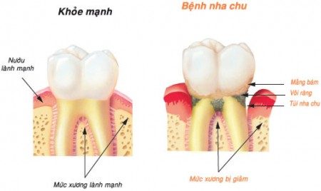 Bệnh nha chu có chữa được không?