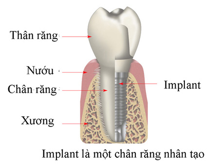 Răng được cấy ghép Implant