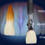 Cấu trúc của răng cấy ghép Implant