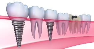 Cấy ghép Implant giúp răng chắc khỏe hơn