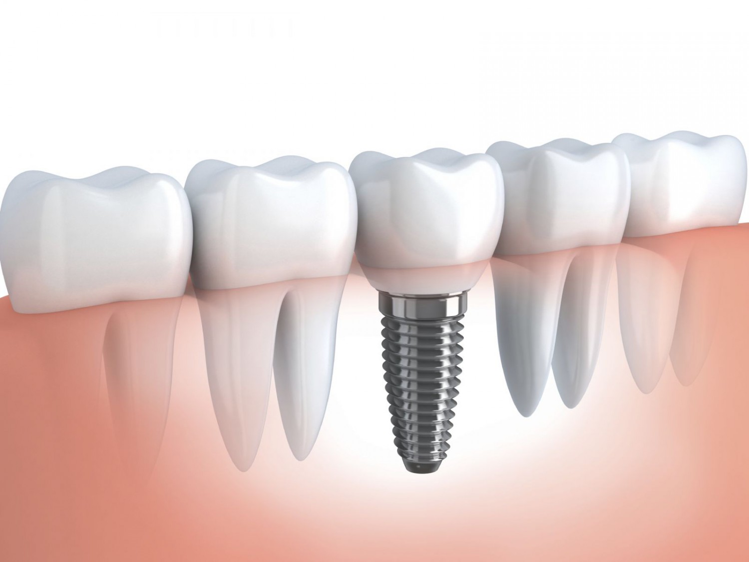 Mô hình răng cấy ghép Implant