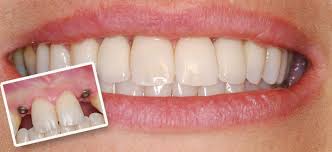 Chăm sóc răng miệng kém dẫn đến viêm quanh implant