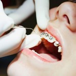 Chi phí của các phương pháp niềng răng hiện nay