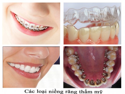 Các phương pháp niềng răng hiện nay