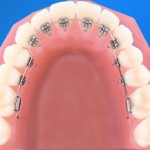 Điều trị các bệnh răng miệng với niềng răng thẩm mỹ