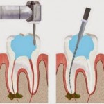 Điều trị tủy răng như thế nào?