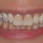 Khi răng nhiễm Tetracycline phải làm gì ?