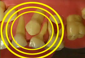 Nhổ răng khôn có nên không ?
