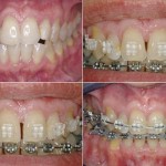 Niềng răng mất bao lâu mới có hàm răng đẹp ?