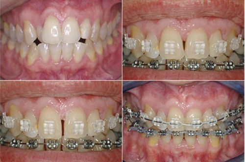 Niềng răng là quá trình chỉnh nha bằng khí cụ nha khoa