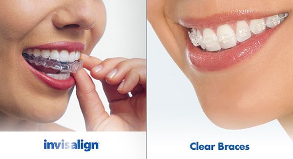 Hai loại niềng răng trong suốt
