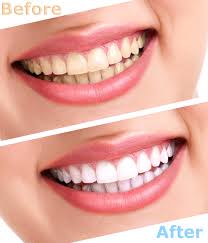 Tẩy trắng răng có thể giữ được màu 3 đến 4 năm