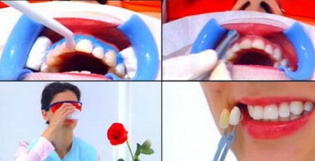 Tẩy trắng răng có giữ được lâu không ?