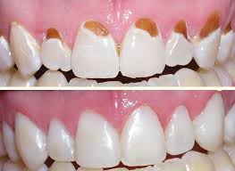 Trám răng thẩm mỹ khắc phục răng sâu, răng mẻ