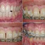 Cách khắc phục khớp cắn hở khi răng bị hô