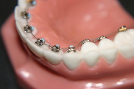 Niềng răng sẽ giúp bạn nắn chỉnh lại hàm răng