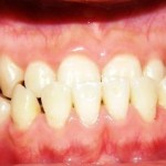 Khớp cắn ngược có niềng răng một hàm được không?