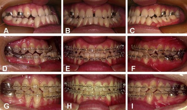 Thời gian niềng răng mất bao lâu ?