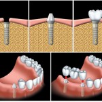Trồng răng giả có duy trì được lâu không?