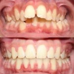 Giá niềng răng hô hàm trên bao nhiêu ?