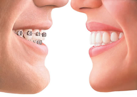 Niềng răng Clear Aligner thuận tiện và thẩm mỹ hơn