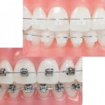 Niềng răng có những phương pháp nào ?