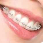 Niềng răng móm được thực hiện như thế nào ?
