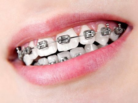 Các mức độ răng hô cơ bản