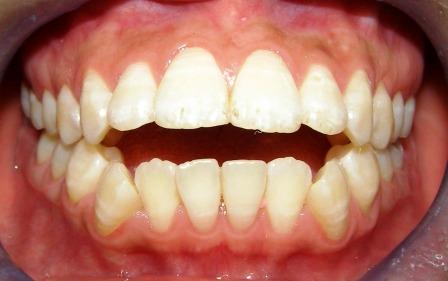 Niềng răng một hàm hay hai hàm khi răng hô hiệu quả