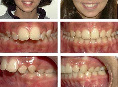Nên niềng răng một hàm hay hai hàm khi răng hô