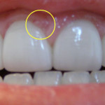 Nưới răng dẫn đến nguy cơ mắc bệnh tim mạch