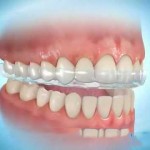 Tác hại của bệnh nghiến răng và cách khắc phục