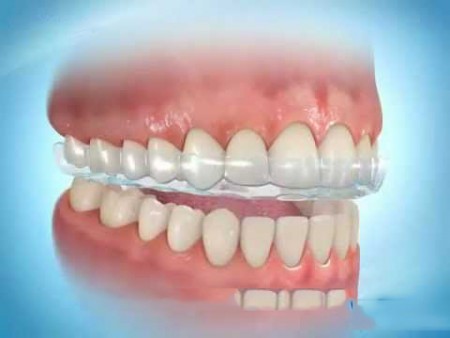 Tác hại của bệnh nghiến răng và cách khắc phục