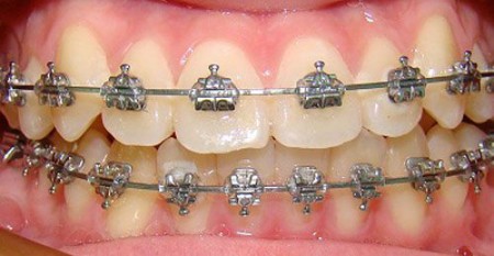 Thẩm mỹ hàm răng bằng cách niềng răng