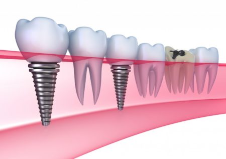 Cấy ghép Implant nâng đỡ răng như thế nào ?